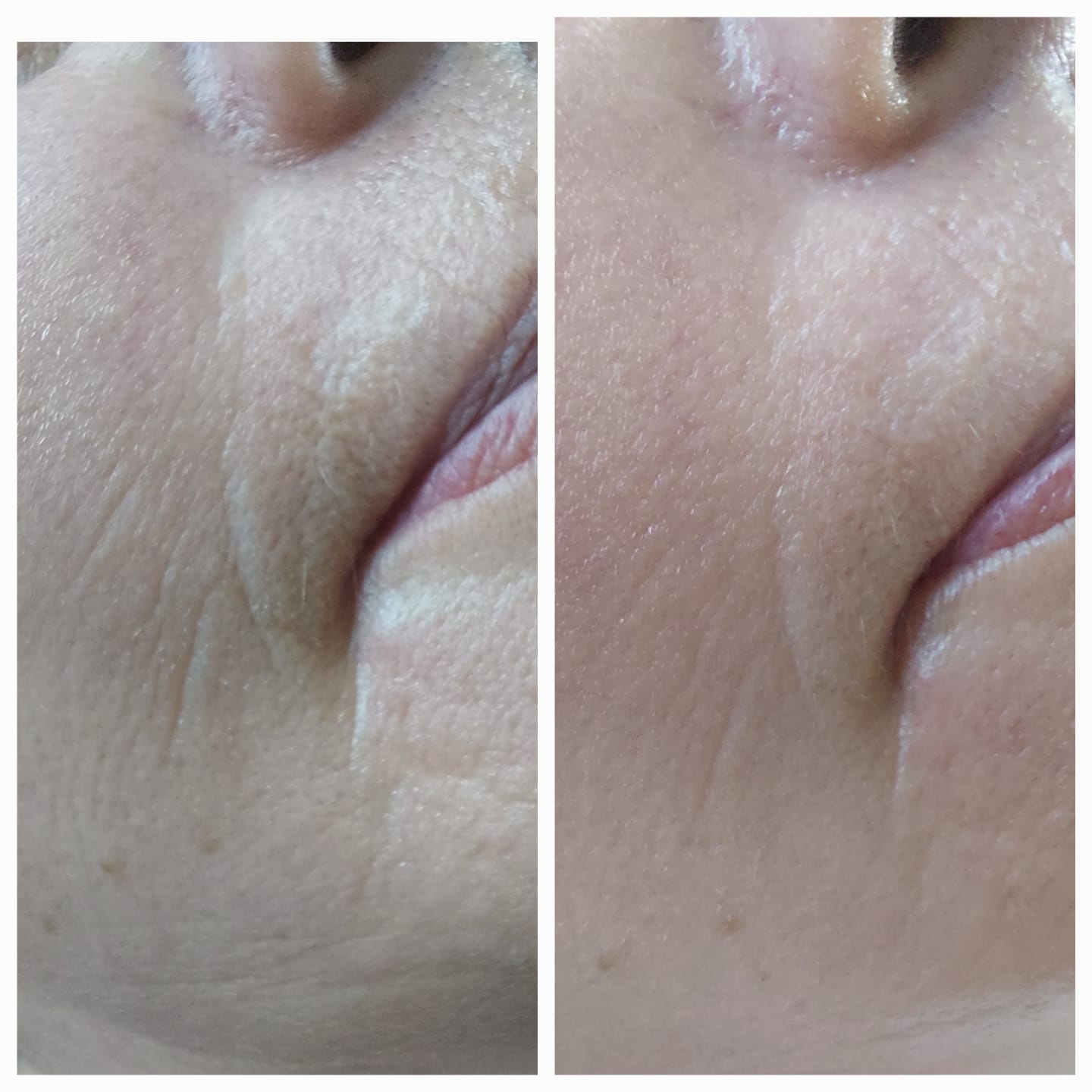 Microneedling Online Schulungsvideo mit Zertifikat